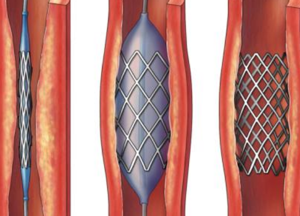 好消息！700元冠脈支架來了帶量采購結(jié)果在甘肅省正式落地執(zhí)行